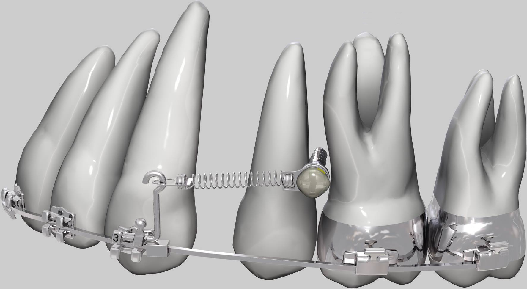 Микроимпланты в ортодонтии 